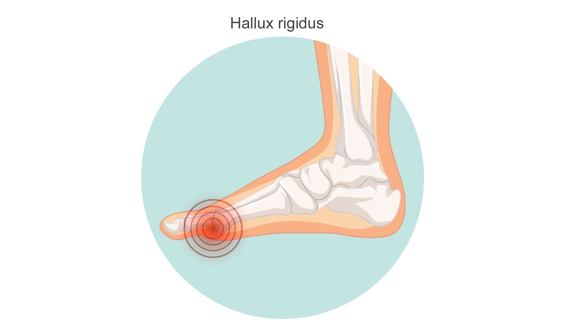 Illustration eines Hallux rigidus: Das Großzehengrundgelenk verbindet den Mittelfußknochen und den ersten Zehenknochen.