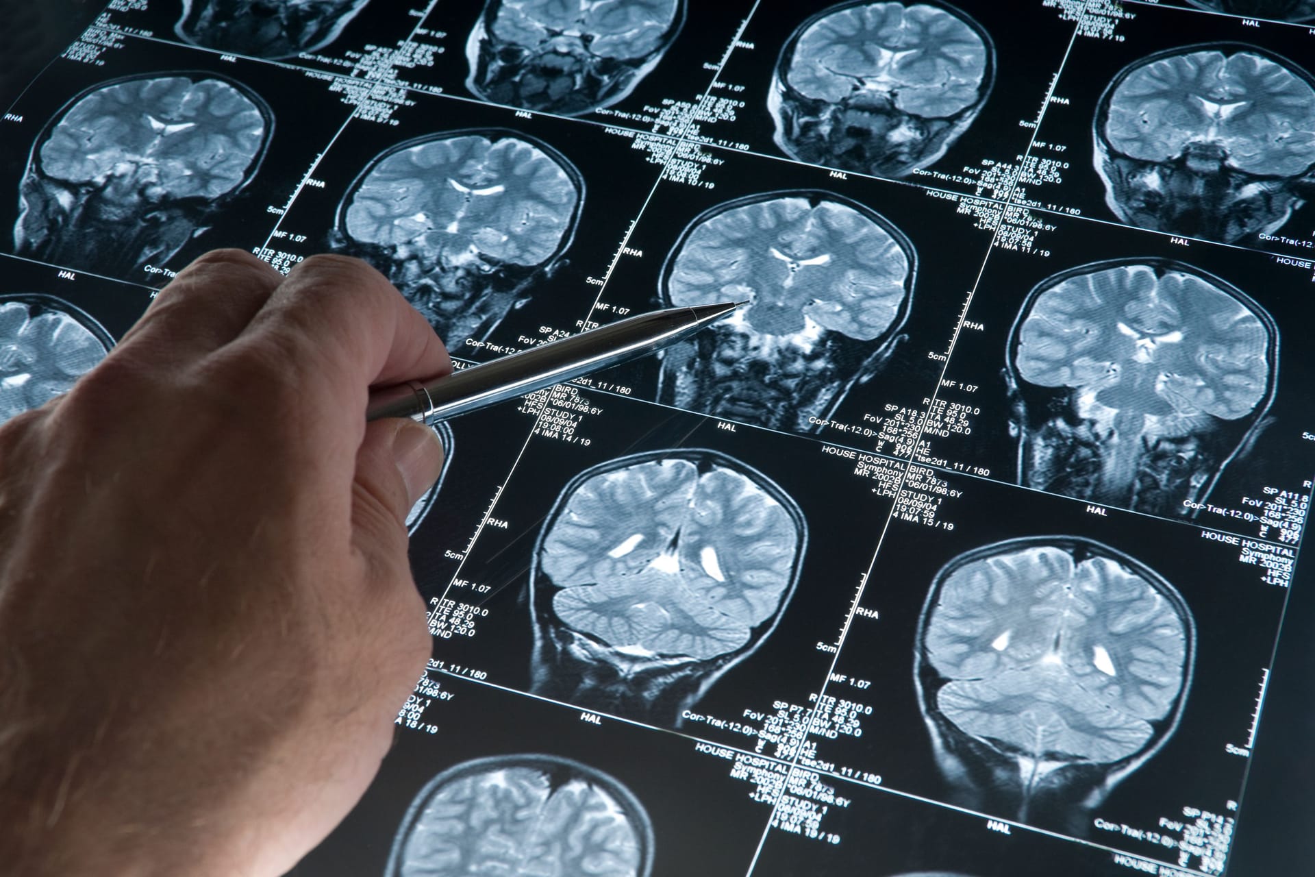 Geistiger Abbau: Er ist bei Demenzerkrankungen wie Alzheimer beschleunigt.