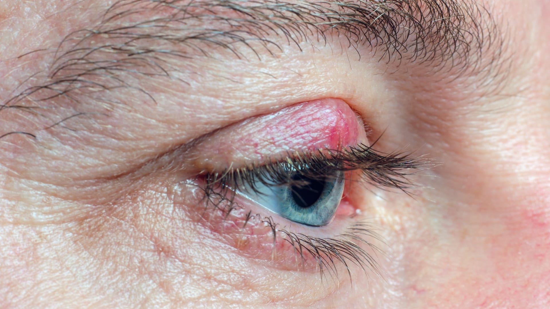Hagelkorn am Auge: Optisch ähnelt es dem Gerstenkorn. Hagelkorn am Auge: Optisch ähnelt es dem Gerstenkorn.