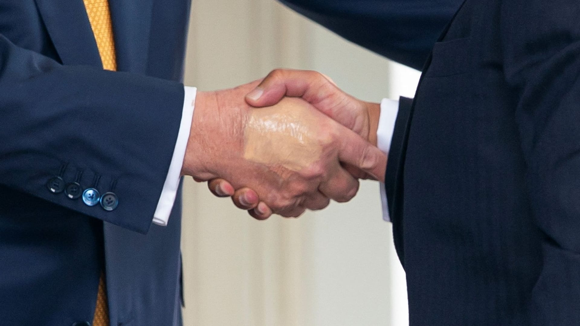 Donald Trump beim Handschlag (links): Das Weiße Haus hat eine Gefäßerkrankung des US-Präsident bestätigt.