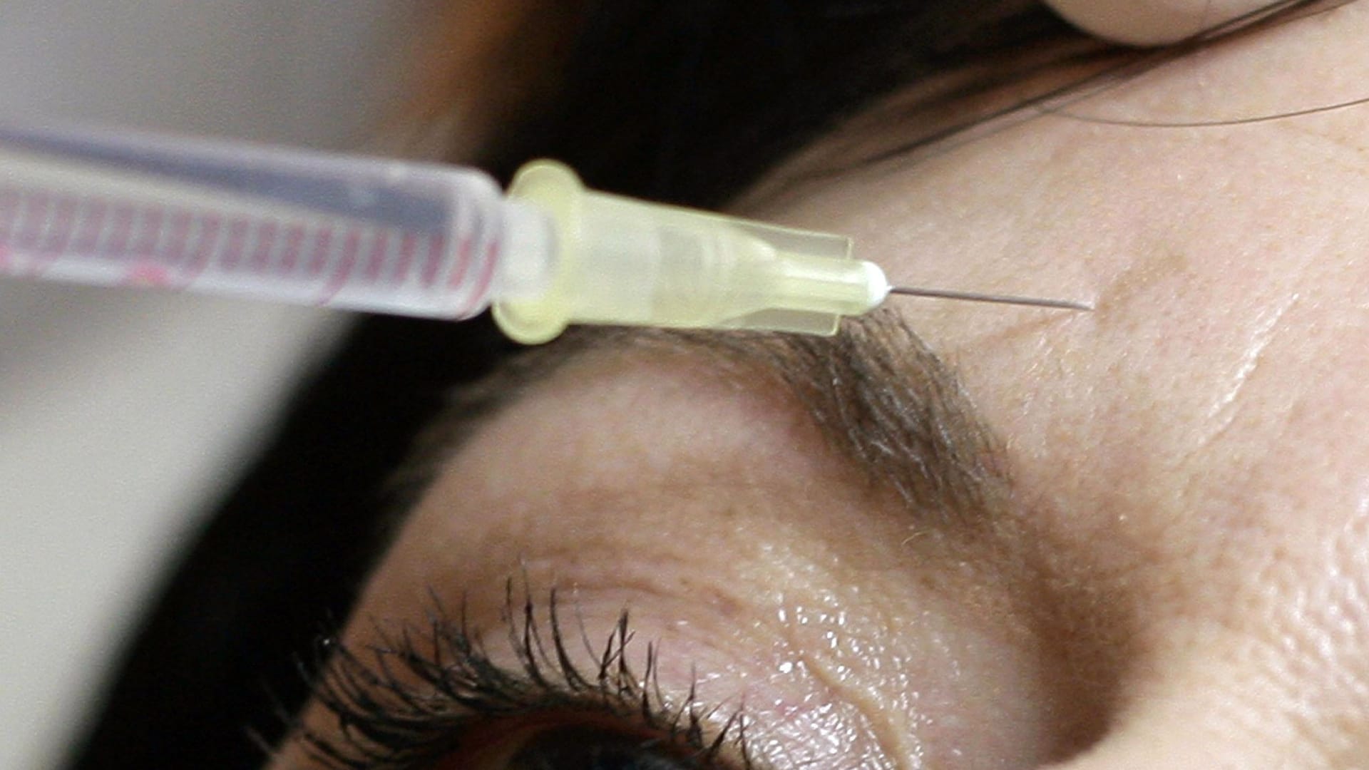 Botox