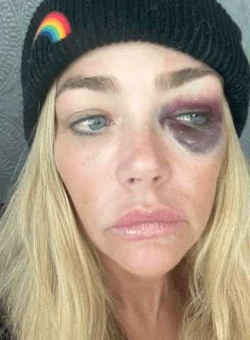 Denise Richards: Bilder von ihren Blessuren kursieren in den sozialen Medien.