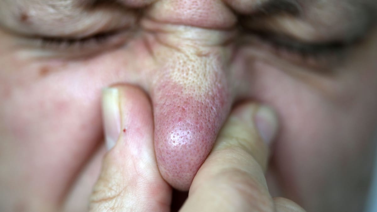 Blähungen beim Fliegen: So beugen Sie vor und das hilft