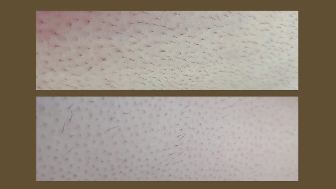 Ergebnis nach fünf Wochen: Oben sehen Sie die Beinbehaarung unserer Redakteurin vor der Behandlung und unten nach der Behandlung. Ergebnis nach fünf Wochen: Oben sehen Sie die Beinbehaarung unserer Redakteurin vor der Behandlung und unten nach der Behandlung.