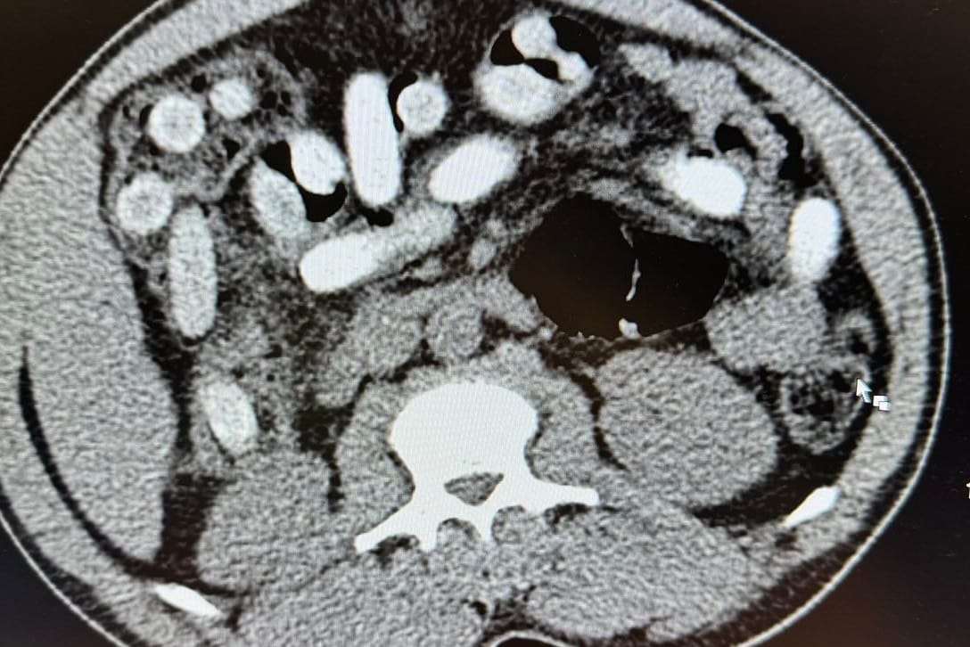 In der Radiologie kamen die sogenannten Bodypacks des Italieners zum Vorschein: 111 Stück an der Zahl.