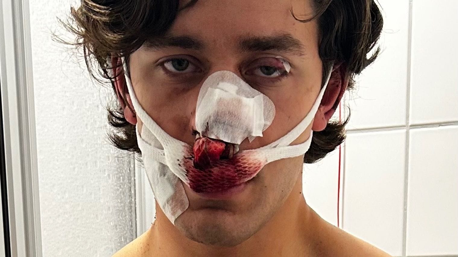 Person mit schweren Verletzungen im Gesicht: Mehr als 20.000 Euro wurden bereits für den verletzten US-Amerikaner gesammelt. Person mit schweren Verletzungen im Gesicht: Mehr als 20.000 Euro wurden bereits für den verletzten US-Amerikaner gesammelt.