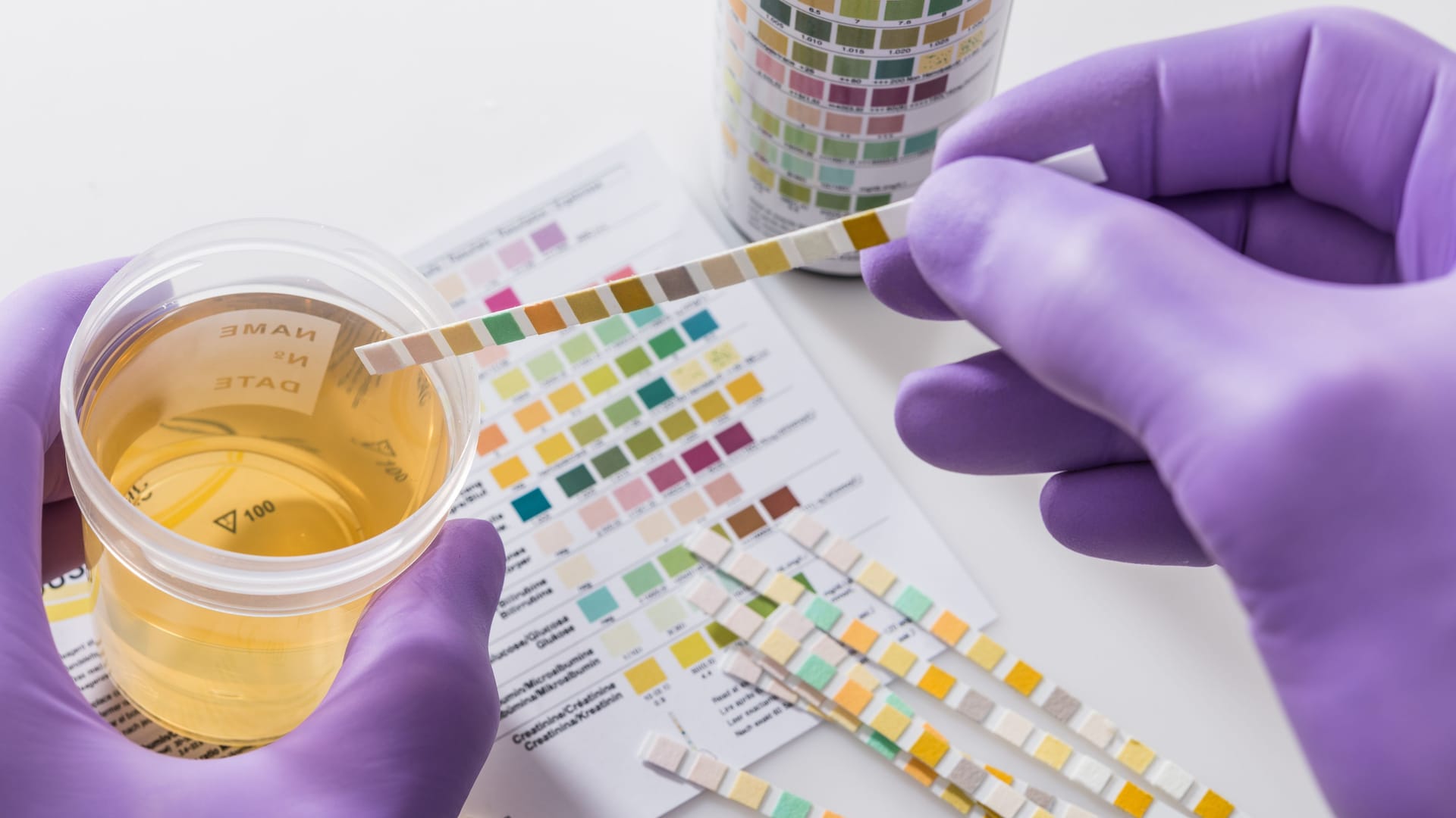 Man sieht eine Urinprobe und Urinteststreifen: Für die Analyse von Urin stehen verschiedene Tests zur Verfügung.