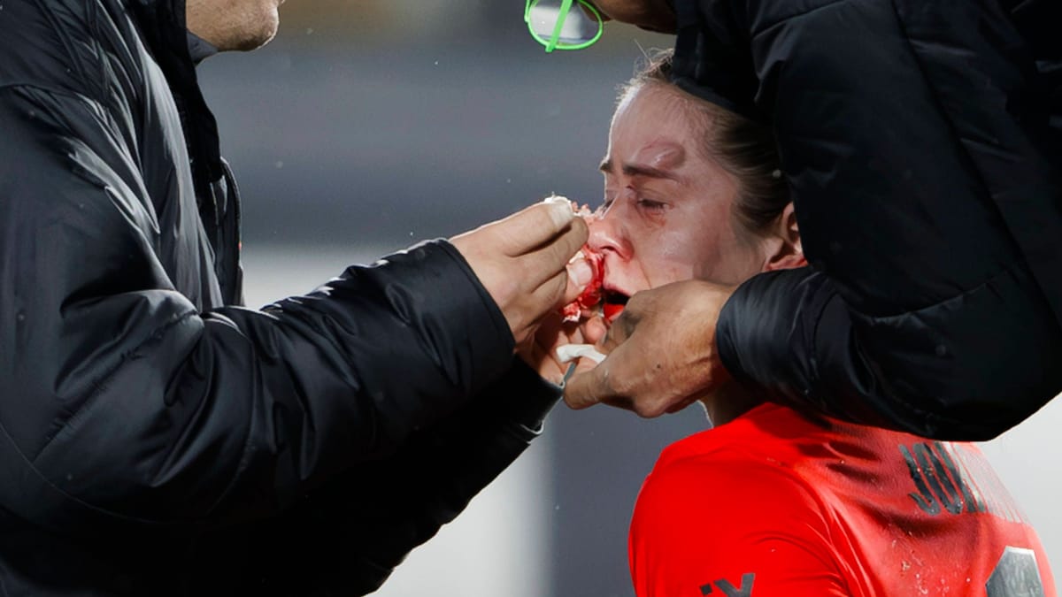 DFB-Torhüterin fehlt VfL Wolfsburg mit Gesichtsfraktur DFB-Torhüterin fehlt VfL Wolfsburg mit Gesichtsfraktur